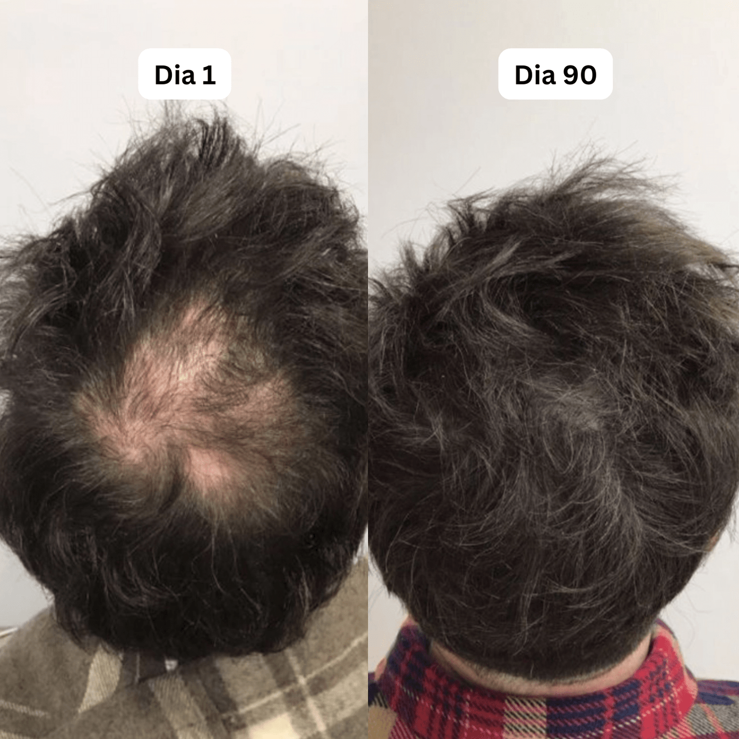 Sormira™ Roll-On Anti-Queda