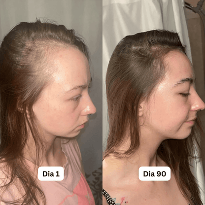 Sormira™ Roll-On Anti-Queda